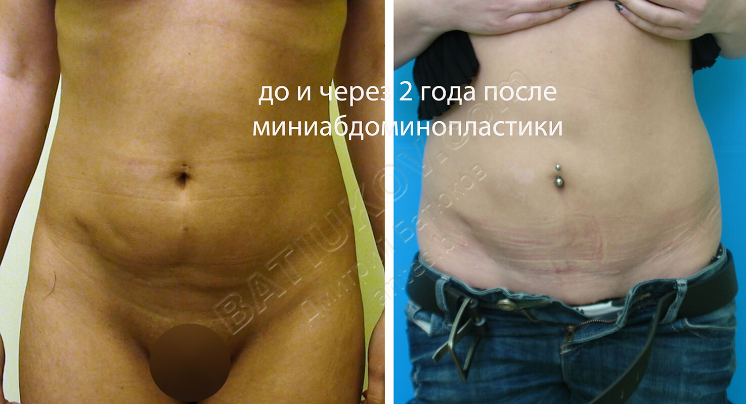 Влагалище После Родов Фото