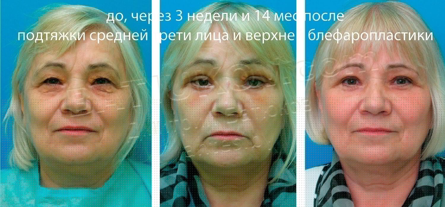 Мононити Для Подтяжки Лица Отзывы Фото