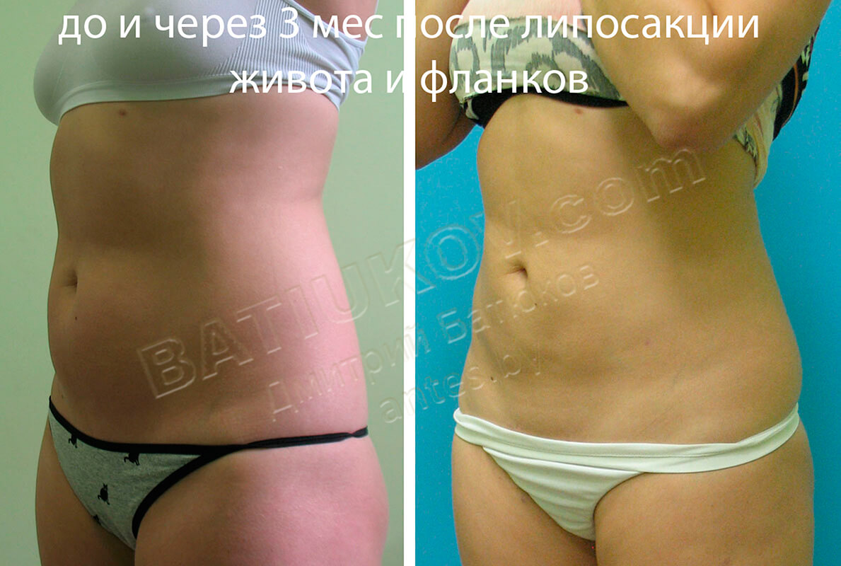 Липосакция Живота Цена