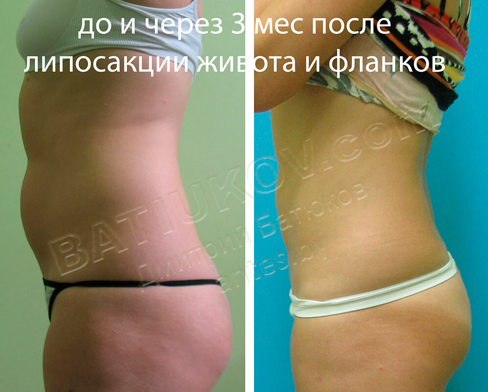 Липосакция Что Это Такое Фото